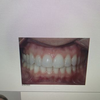 TLC for Smiles - Chatsworth - Before and After - Orthodontists Near Me - Chatsworth, California TLC for Smiles - Chatsworth - Before and After - Orthodontists Near Me - Chatsworth, California