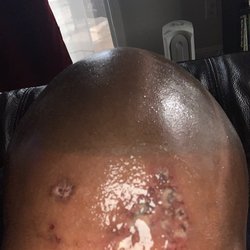 David Creech, MD - Blisters that formed two days after the procedure.