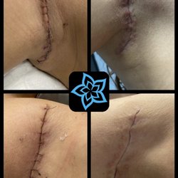 Properly aiding in scar healing post surgery