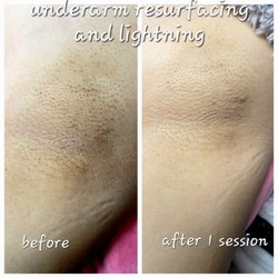 Mystic Moon Esthetics - Before and after skin resurfacing