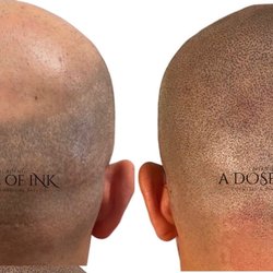A Dose Of Ink - Scalp Micropigmentation