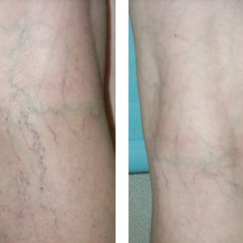 Dubow Dermatology - Beverly Hills Dermatologist Dr. Dubow offers sclerotherapy. - Dermatologists Near Me - Beverly Hills, California Dubow Dermatology - Beverly Hills Dermatologist Dr. Dubow offers sclerotherapy. - Dermatologists Near Me - Beverly Hills, California