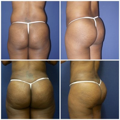 Brazilian Butt Lift/Fat Transfer to Buttocks - Best Brazilian Butt Lift Southern California. Call Dr Pearlman Hicks now for free consultation at 562-595-9493. Brazilian Butt Lift/Fat Transfer to Buttocks - Best Brazilian Butt Lift Southern California. Call Dr Pearlman Hicks now for free consultation at 562-595-9493.