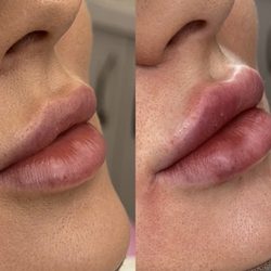 Amber Beauty Lounge - Lip augmentation before and after