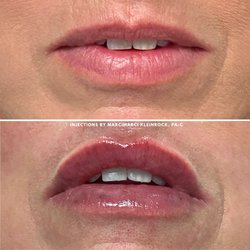 The Laser & Rejuvenation Center - Lip filler by Marci