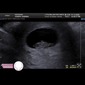 Little Bellies - Our little nugget! Love this place - Ultrasound Imaging Centers Near Me - Fort Worth, Texas