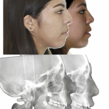 PhD Orthodontics - Open Bite
Extraction Tx
Before After - Orthodontists Near Me - San Gabriel, California PhD Orthodontics - Open Bite
Extraction Tx
Before After - Orthodontists Near Me - San Gabriel, California