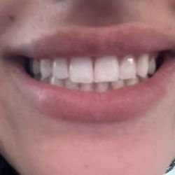 Devoted Dental - This is me after a cleaning and a few pain free fillings!