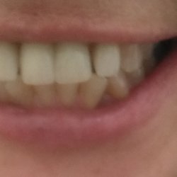 QDT dental - Gaps are visible.