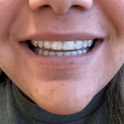 Anaheim Dental & Orthodontics - No braces and Invisalign retainers!