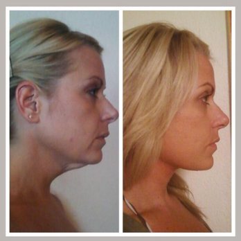 Raad Taki, MD - Lower facelift 2014. After pic is 10 days after surgery. Thank you Dr. Taki!!! - Cosmetic Surgeons Near Me - Tucson, Arizona Raad Taki, MD - Lower facelift 2014. After pic is 10 days after surgery. Thank you Dr. Taki!!! - Cosmetic Surgeons Near Me - Tucson, Arizona