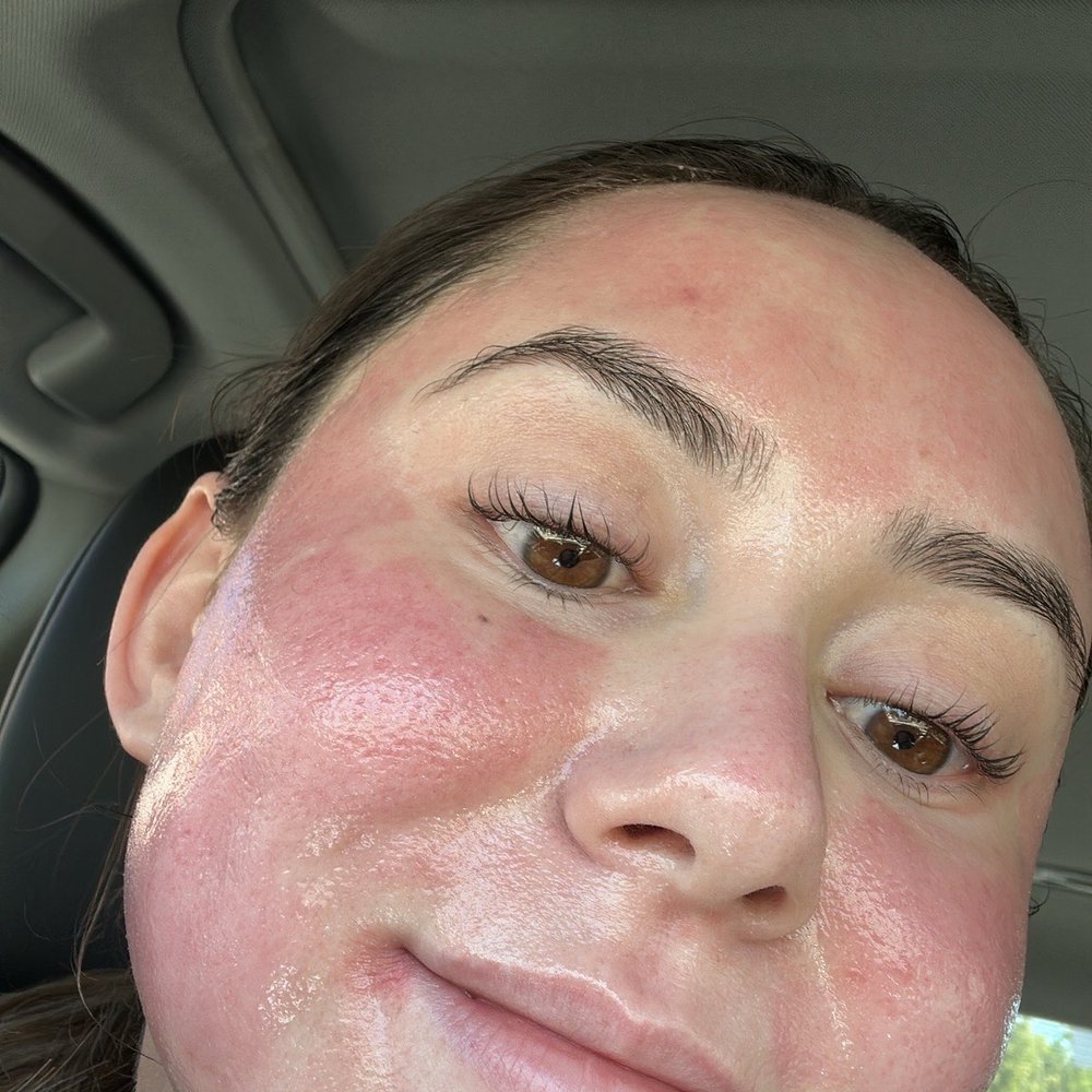 Celleste - Skin literally right after fractional laser treatment - Skin Care Near Me - Buena Park, California