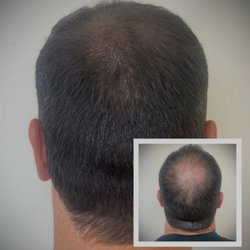 Revolution Scalp Micropigmentation