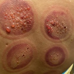 Kern David - Grace Health Center - Dr. David Kern, ND, Maui Hi *I Do Not Recommend! This is from his cupping, Second Degree Burns! and Scarring!