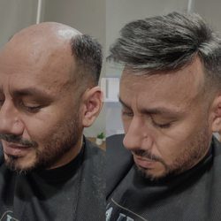 Albacuts - Hair systems deliver immediate fullness and can be tailored to match natural hair, offering a reversible and non-invasive solution.