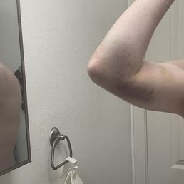 Bruising from slipped needle.