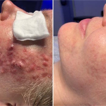 Thrēo Skin - Before: late June 2020, After: January 2021 - Skin Care Near Me