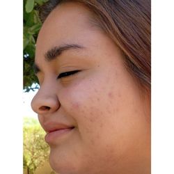 Utopia Image - Next day results after Laser Acne Treatment