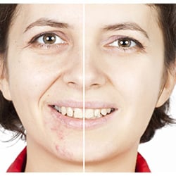 Four Season Spa - Acne treatment
