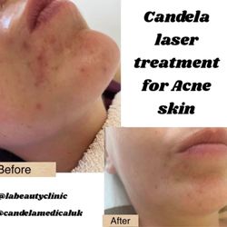 LA Beauty Clinic - Our New IPL laser machine from Candela