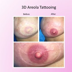 3 D Areola Tattoo