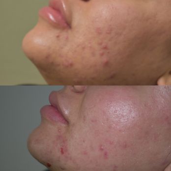 Exclusively Glamorous - Microneedling with PRP - Medical Spas Near Me - Prescott Valley, Arizona