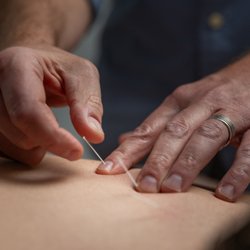 Inner Gate Health & Wellness - Acupuncture needles painlessly inserted into upper back muscles to relieve back tension.