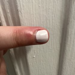 My Friends Nail Spa - Infected finger