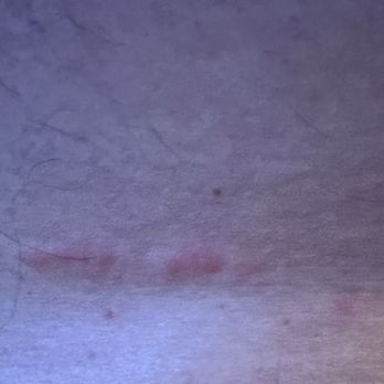 DoubleTree by Hilton Hotel Irvine - Spectrum - Bug bites from the bed - Hotels Near Me - Irvine, California