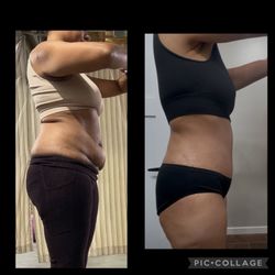 Precision Medical Specialists - Before and after Max Tuck "tummy tuck" and 360 Lipo