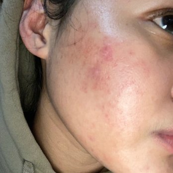 LC INK & SKIN - Before LA ELLE BEAUTY microneedling. Was dealing with redness, extremely oily skin, acne scars, and hyperpigmentation! - Skin Care Near Me - Montebello, California LC INK & SKIN - Before LA ELLE BEAUTY microneedling. Was dealing with redness, extremely oily skin, acne scars, and hyperpigmentation! - Skin Care Near Me - Montebello, California