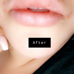 Before-N-After - Those are breakouts from the new face treatment I'm using nothing to do with the fillers.