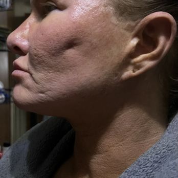 Blackledge Face Center - After cheek implant removal. Implants were lopsided, extremely painful, shifted, red, swollen, & embarrassing. - Cosmetic Surgeons Near Me - Jackson, Mississippi