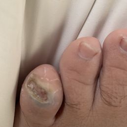 Toe nail