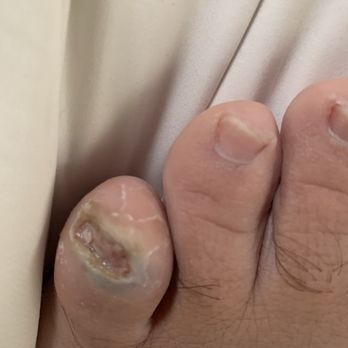 Tower Podiatry - Toe nail - Podiatrists Near Me - Los Angeles, California