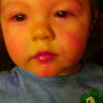 Zankou Chicken - My son in anaphylaxis after eating at Zankous Chicken - Mediterranean Near Me - Montebello, California Zankou Chicken - My son in anaphylaxis after eating at Zankous Chicken - Mediterranean Near Me - Montebello, California
