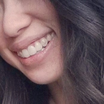 Incredible Dentistry - Clear correct, you can't even tell I have them on except the clear bracket. - Cosmetic Dentists Near Me - Irving, Texas