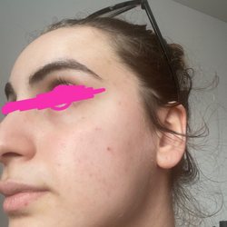 Peachy Skin Care - My skin had a deep indent with redness and she healed it. She also calmed down my overall rosacea and acne scars.