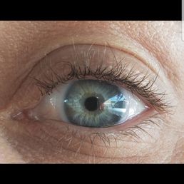 2mo later April 25, 2019. Right eye. 2mo later April 25, 2019. Right eye.
