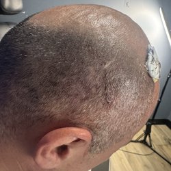 Salar Hazany MD - Skin graft