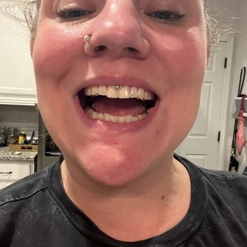 ASAP Dental Care - You can't even tell which tooth was chipped - Oral Surgeons Near Me - Jacksonville, Florida