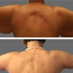 Akkary - Brachioplasty (Arm Lift)