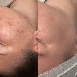 Puresthetics Skin Care - Before and after