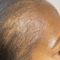 Parker Trichology Centre - After! September 5 months later. Aqua Scalp Therapy