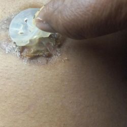 Park Rose Care Center - Feeding tube area infected