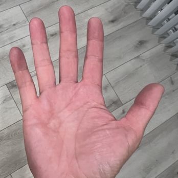 Eureka! - Right hand all red. Burned his hands! - American Near Me - San Diego, California Eureka! - Right hand all red. Burned his hands! - American Near Me - San Diego, California