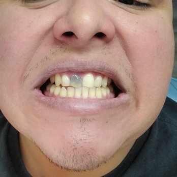 626 Dental Care - Before - General Dentistry Near Me - El Monte, California