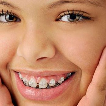 Embrace Smile Studio - Clear Braces at any age - Orthodontists Near Me - Toluca Lake, California Embrace Smile Studio - Clear Braces at any age - Orthodontists Near Me - Toluca Lake, California