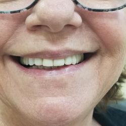 Stephen T Stein, DDS - In progress temporaries