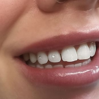 HySmiles - Customized Tooth Gems for the win! - Teeth Whitening Near Me - San Jose, California HySmiles - Customized Tooth Gems for the win! - Teeth Whitening Near Me - San Jose, California